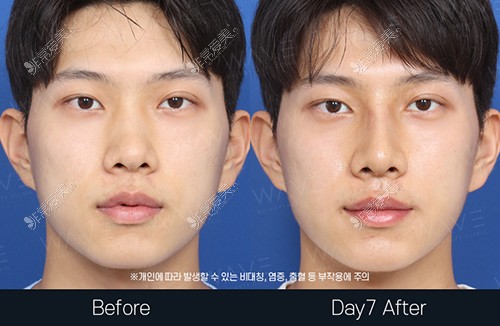 韩国WAVE整形外科隆鼻手术