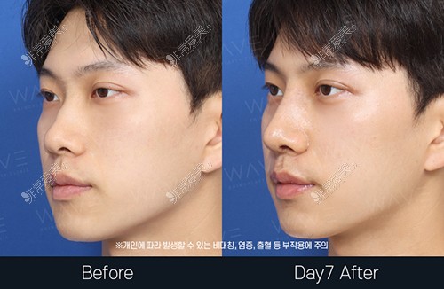 韩国WAVE整形外科隆鼻手术