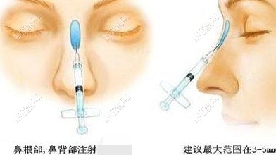 乌鲁木齐做注射隆鼻示意图