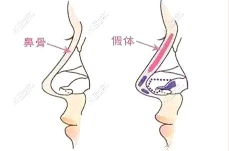 烏魯木齊做注射隆鼻手術(shù)示意圖