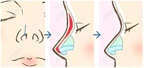 乌鲁木齐胶原蛋白注射隆鼻示意图