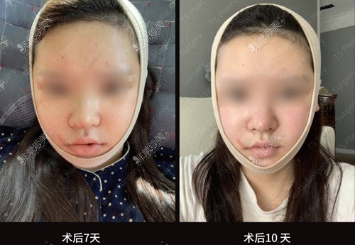 韩国TS整形外科医院全脸改造术后7天和10天