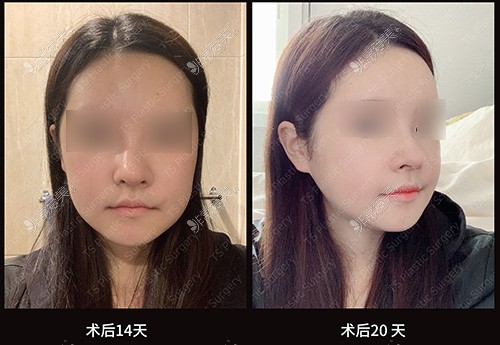 韩国TS整形外科医院全脸改造术后14天20天