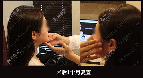 韩国TS整形外科医院全脸改造术后1个月复查