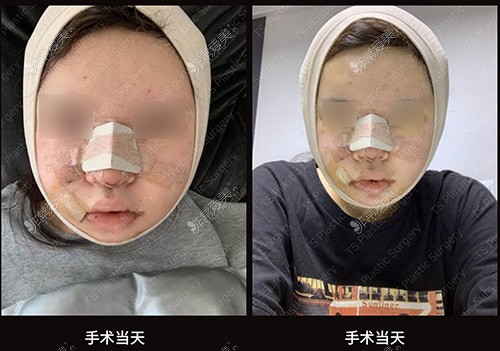 韩国TS整形外科医院全脸改造手术当天很肿