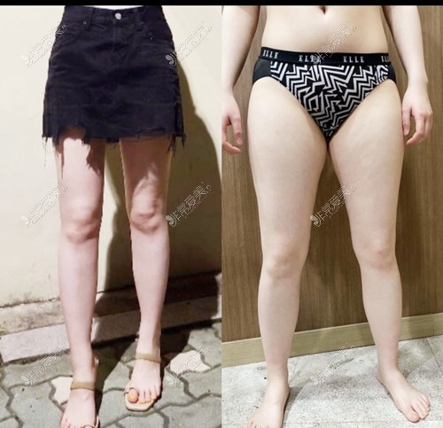 韩国365mc医院大腿吸脂术前术后对比图