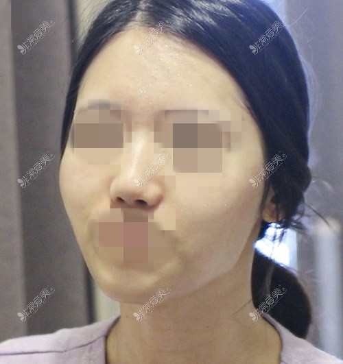 韩国TS整形外科轮廓综合整形术前照