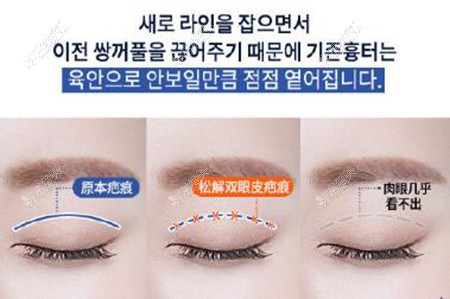韩国TS眼整形改善治疗