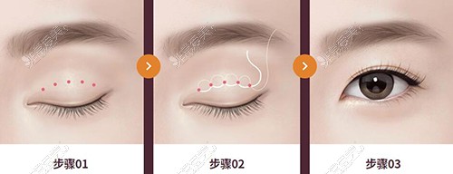 韩国TS整形外科眼整形改善治疗