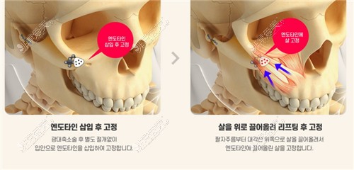 韩国1%整形外科颧骨整形方法
