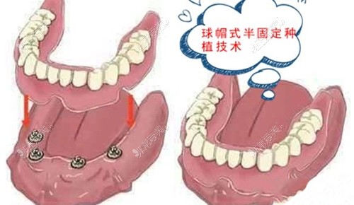 半口半固定假牙修復(fù)