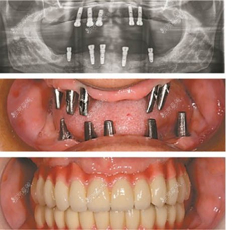 老年全口种植牙修复方式图