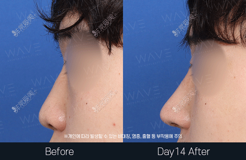 韩国wave鼻子整形对比图