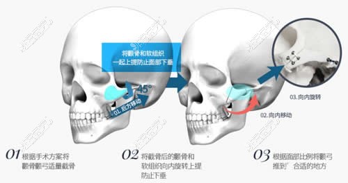 韩国欧佩拉整形颧骨缩小手术分析