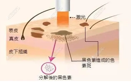 激光祛斑原理图