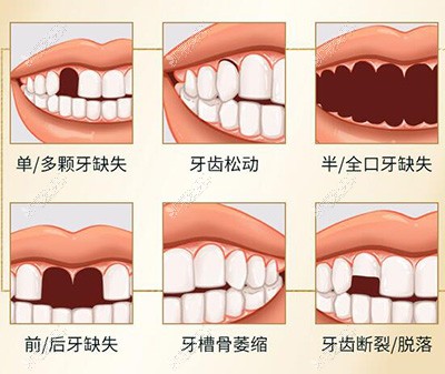 哪些牙齿要做种植改善治疗