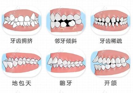 哪些牙齒要做正畸改善治療