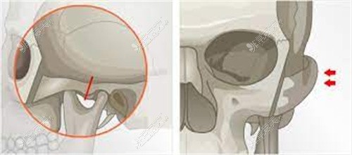 颧骨整形对比图