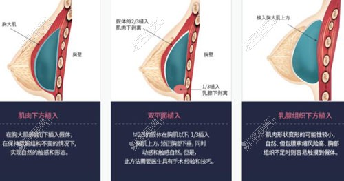 韩国欧佩拉整形外隆胸技术特点展示