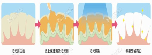 牙齒冷光美白