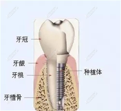 种植牙