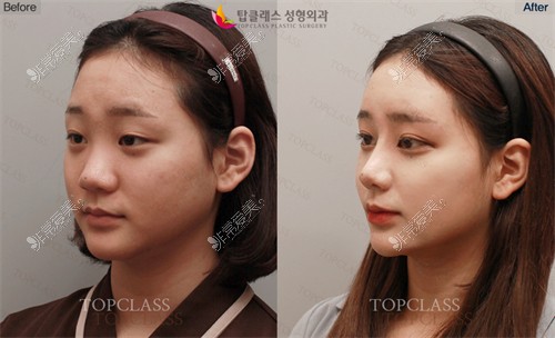韩国TopClass整形外科前后图