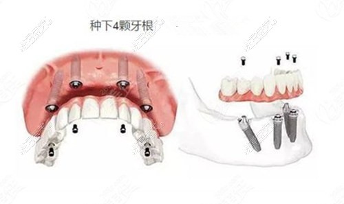 all-on-4种植牙