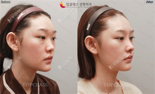 韩国TopClass整形外科做鼻子对比照