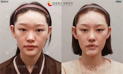 韩国TopClass整形外科做鼻子前后对比图