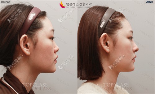 韩国TopClass整形外科做鼻子前后图