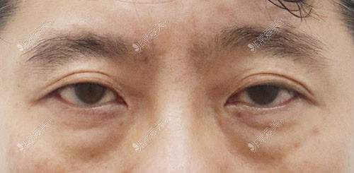 韩国AND整形外科男士眼袋手术前
