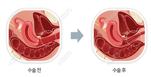 韩国Qline女性医院缩阴手术对比图