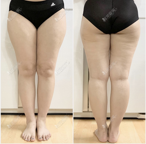 在韩国365mc医院做了大腿+小腿吸脂手术,3周后已经变成这样啦