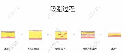 吸脂手術示意圖