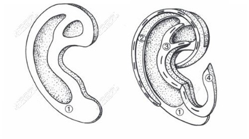 耳再造设计的耳廓假体