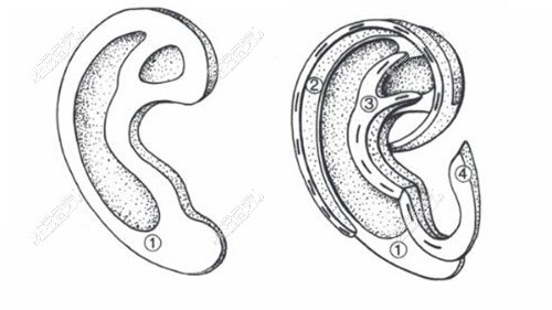 耳再造設計的耳廓假體