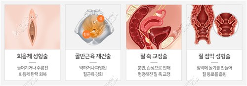 韩国Qline女性医院女性阴道整形项目