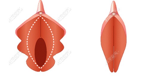 韩国Qline女性医院阴唇整形前后对比