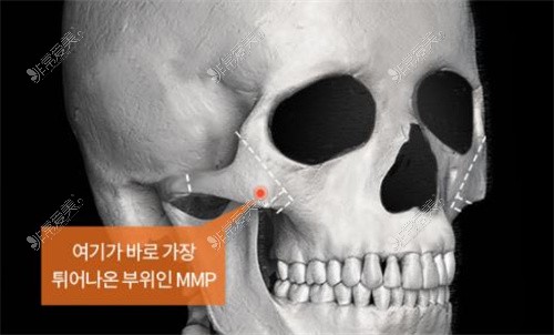 韩国TS整形外科颧骨缩小截骨方式