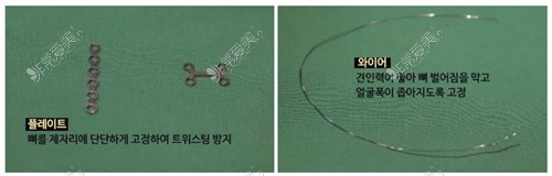 韩国TS整形外科固定钛丝、钛板