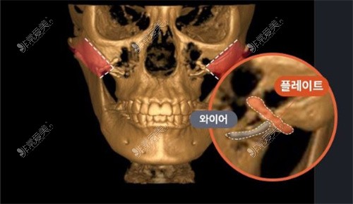 韩国TS整形外科颧骨缩小手术截骨部位展示