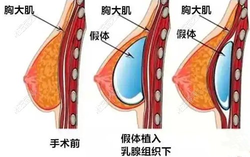 假体隆胸示意图