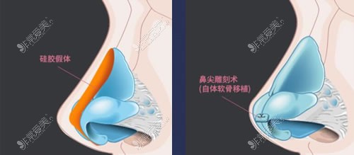 韩国欧佩拉整形隆鼻手术优势展示
