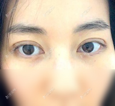 韩国NANA眼睛整形恢复期照片