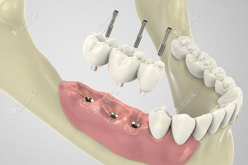 种植牙示意图