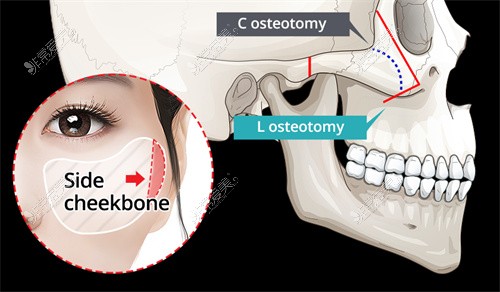 顴骨磨骨手術示意圖