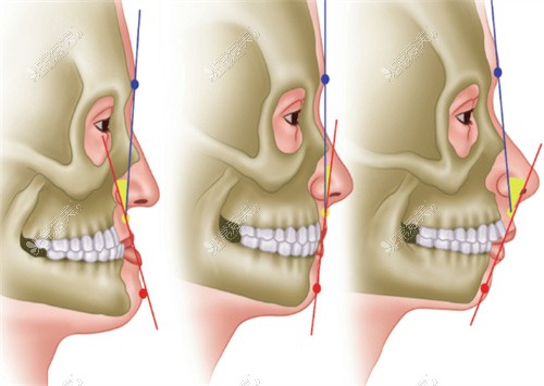 正颌手术对比示意图