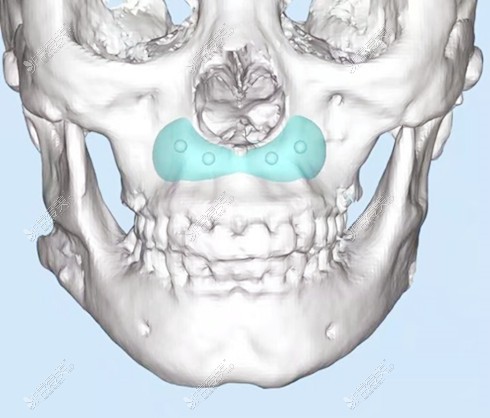 3d打印鼻基底圖示