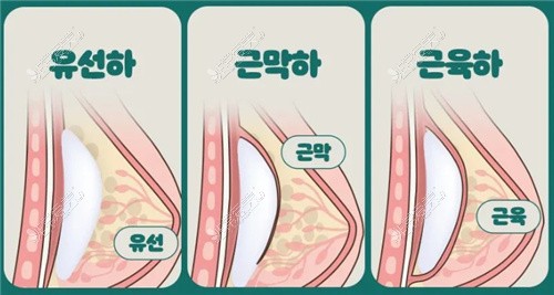 韩国WJ原辰整形外科医院隆胸假体放置位置