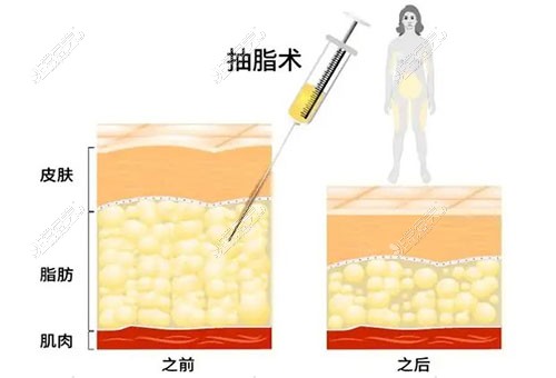 长春腿部吸脂价格是多少？附长春腿部吸脂技术好的医院